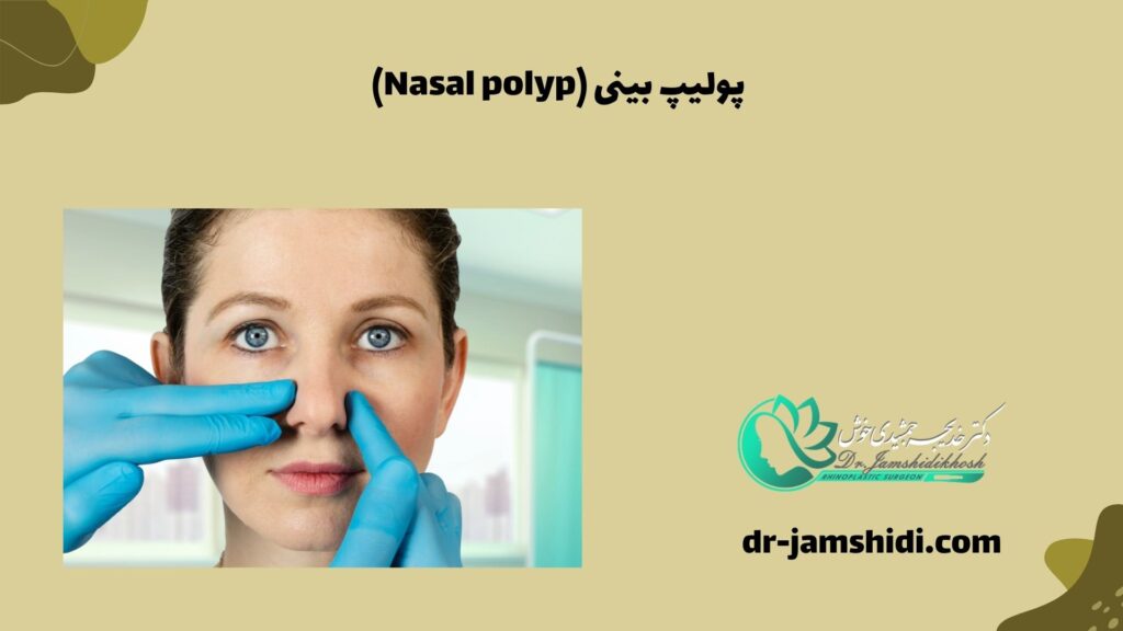 پولیپ بینی (Nasal polyp)
