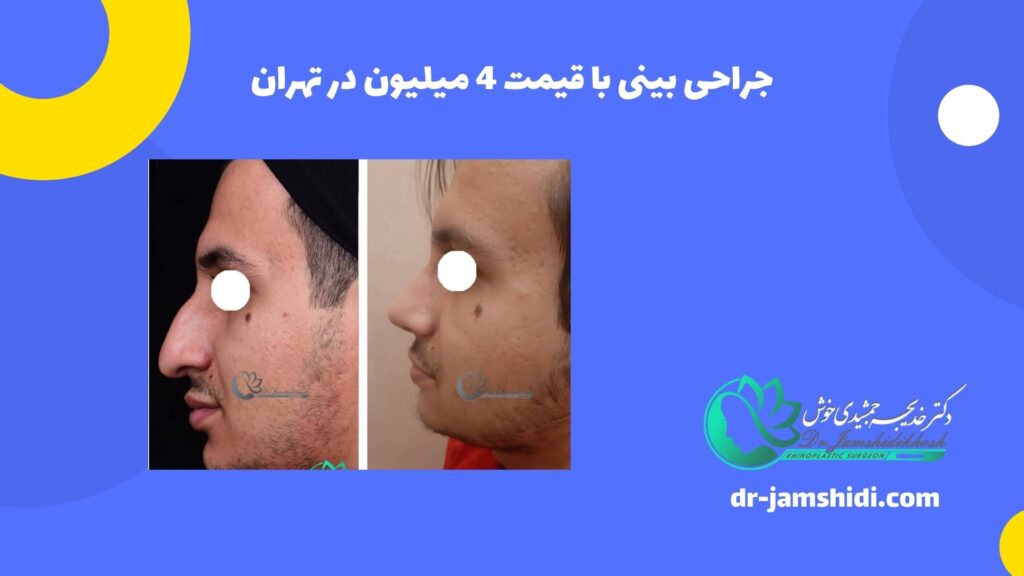 جراحی بینی با قیمت 4 میلیون در تهران