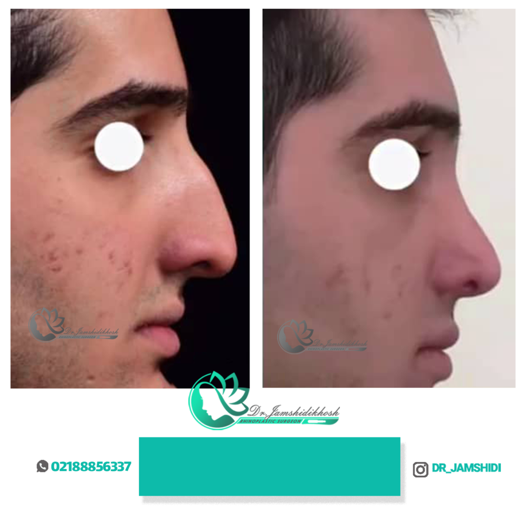 تصاویر قبل و بعد جراحی بینی