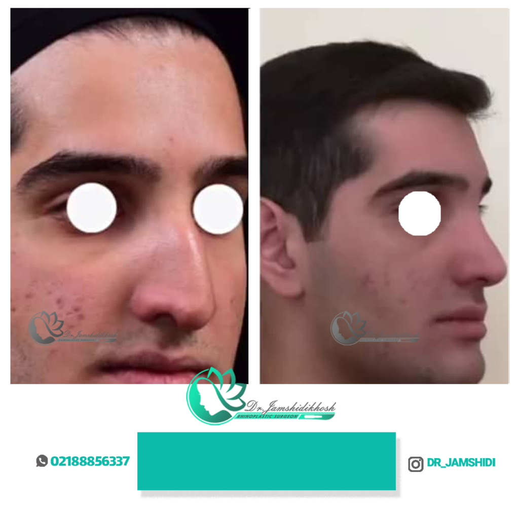 تصاویر قبل و بعد جراحی بینی