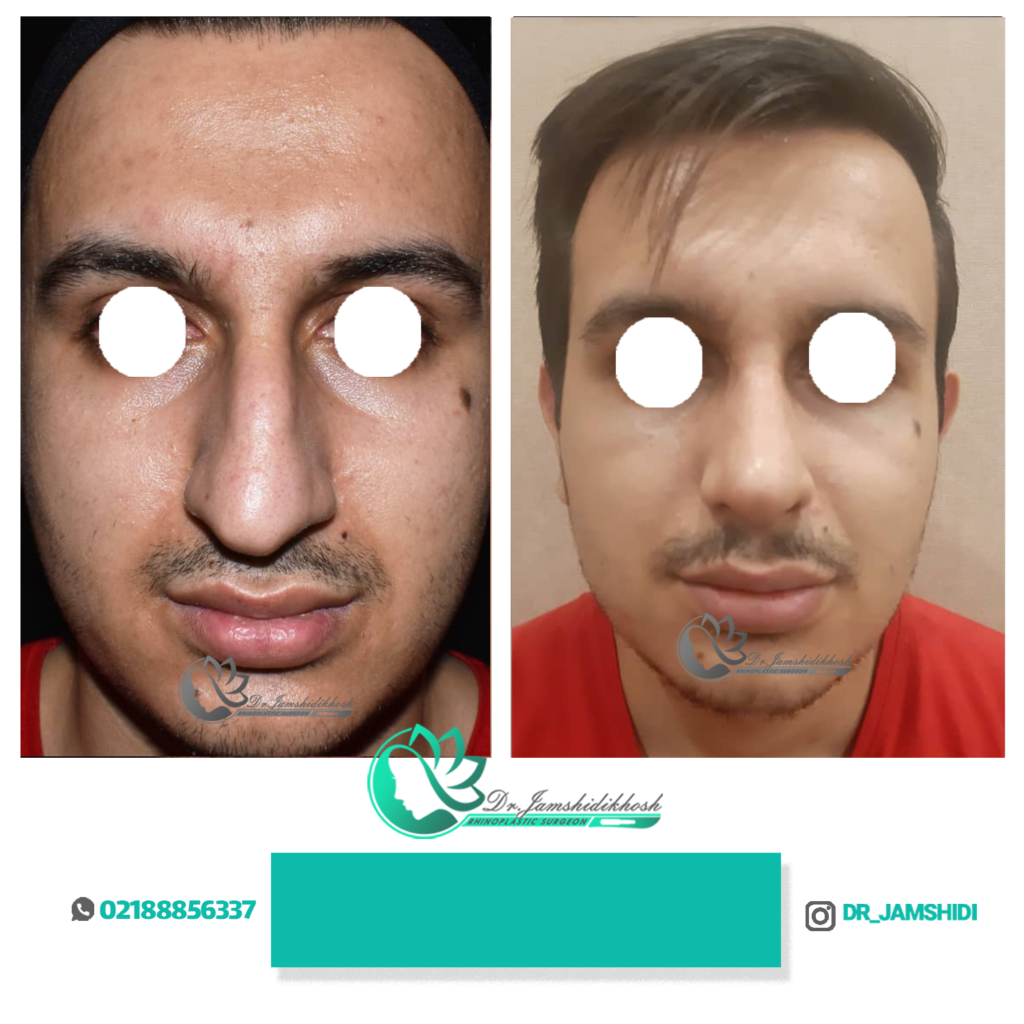 عکس قبل و بعد جراحی بینی دکتر جمشیدی