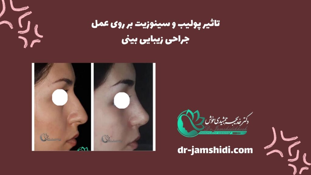تاثیر پولیپ و سینوزیت روی عمل جراحی زیبایی بینی