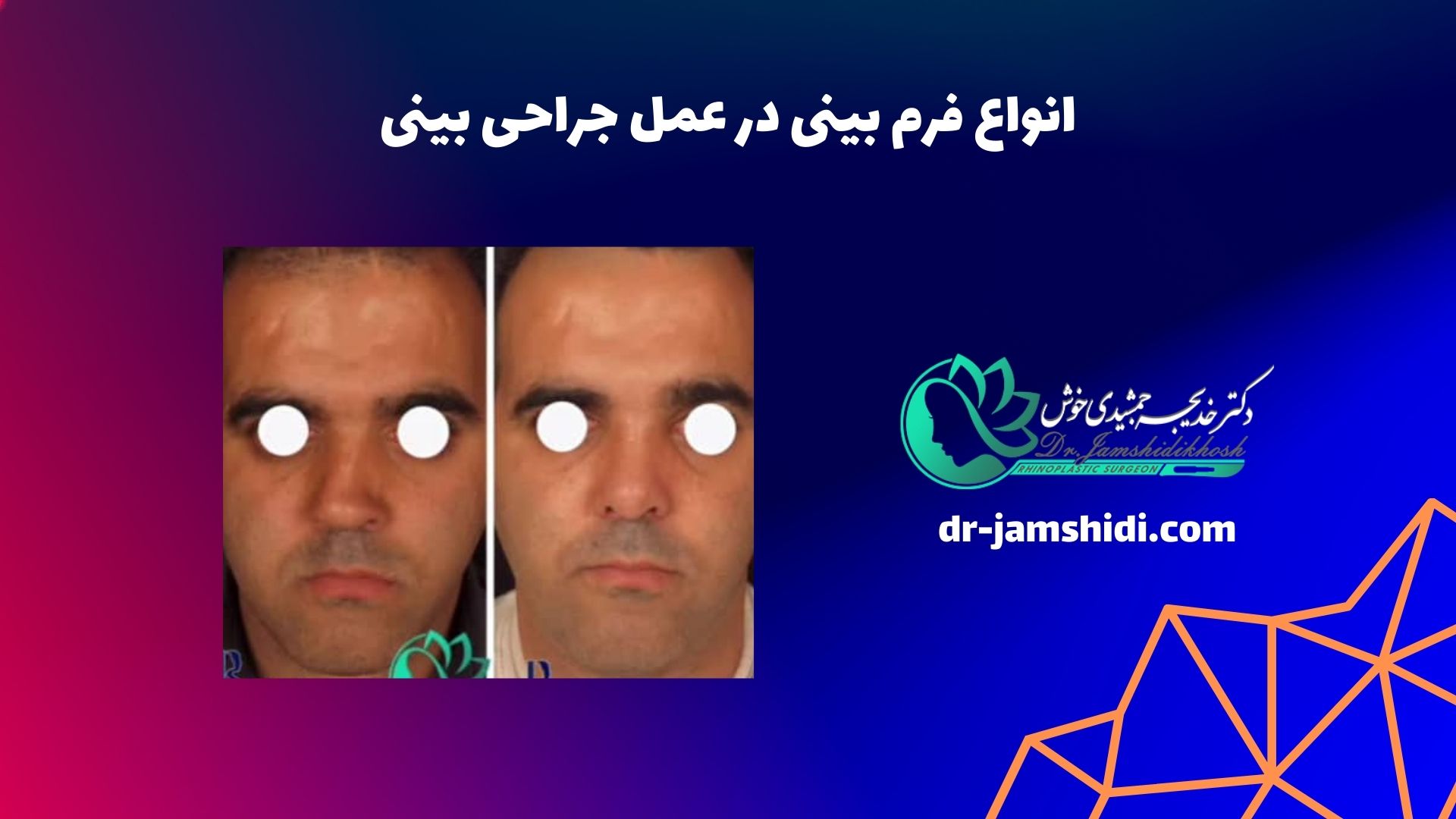 انواع فرم بینی در عمل جراحی بینی