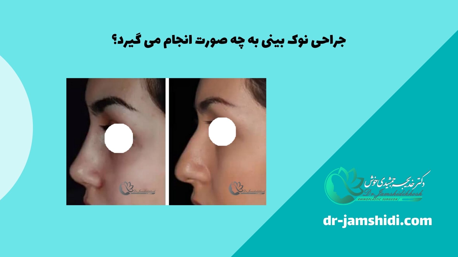 جراحی نوک بینی به چه صورت انجام می گیرد؟