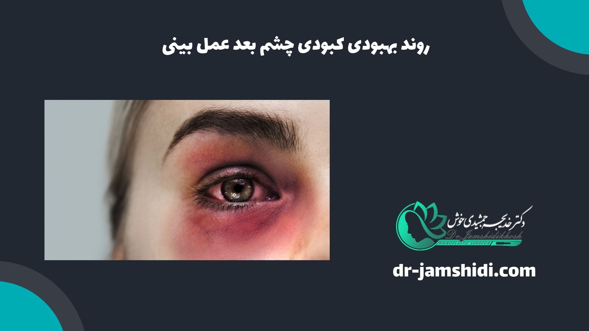 روند بهبودی کبودی چشم بعد عمل بینی