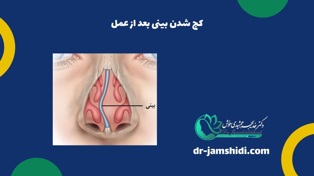 کج شدن بینی بعد از عمل