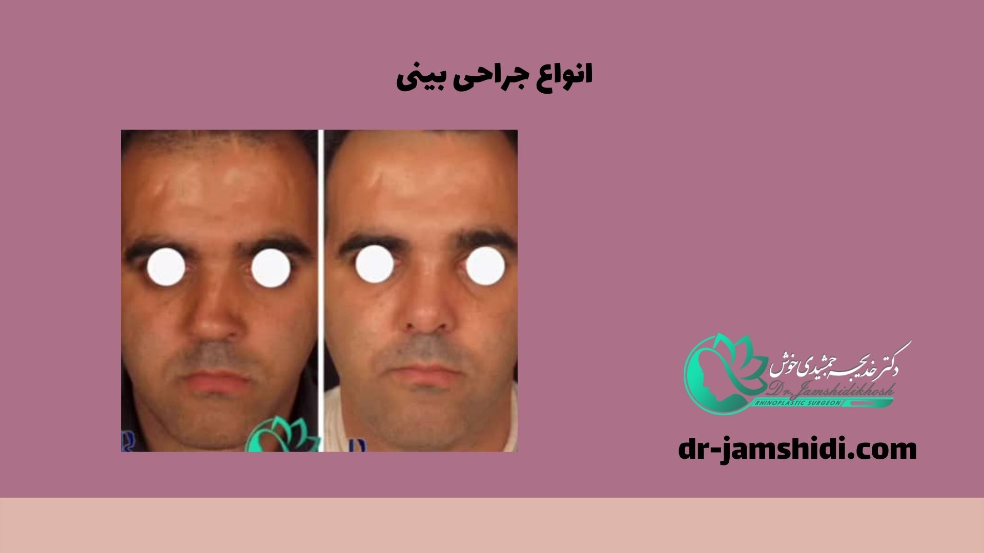 انواع جراحی بینی