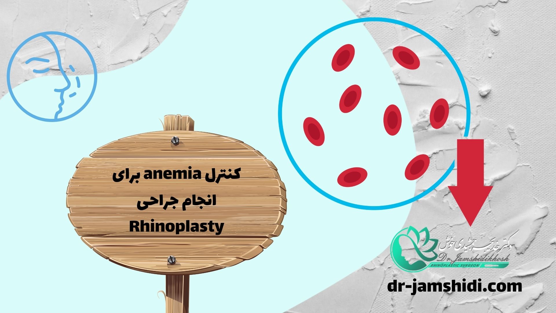 کنترل anemia برای انجام جراحی Rhinoplasty